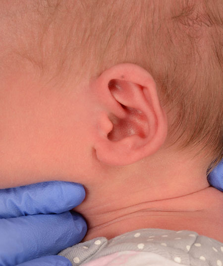 infant's ear before ear molding