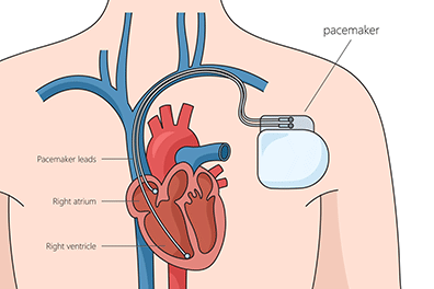 Pediatric pacemaker placement - Children's Health