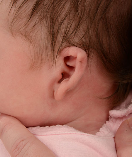 baby with constricted ear before ear molding treatment
