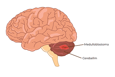 pediatric medulloblastoma - Children's Health