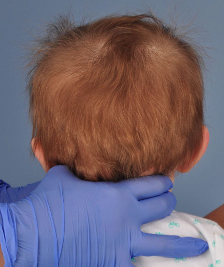baby after strip craniectomy for metopic craniosynostosis