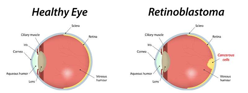 Retinoblastoma in children - Children's Health