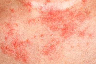 Eczema in children - Children's Health