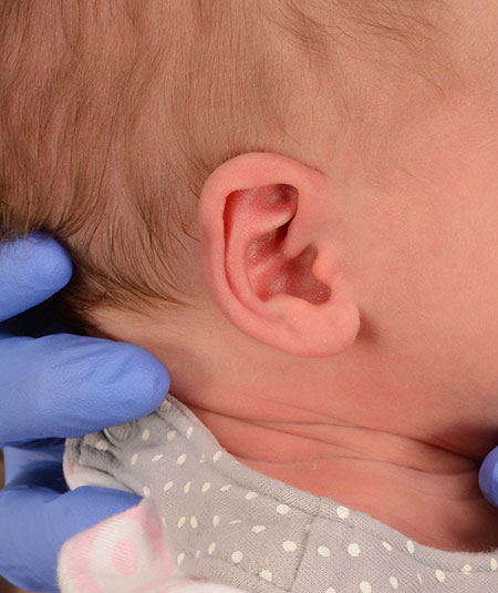 infant's ear before ear molding