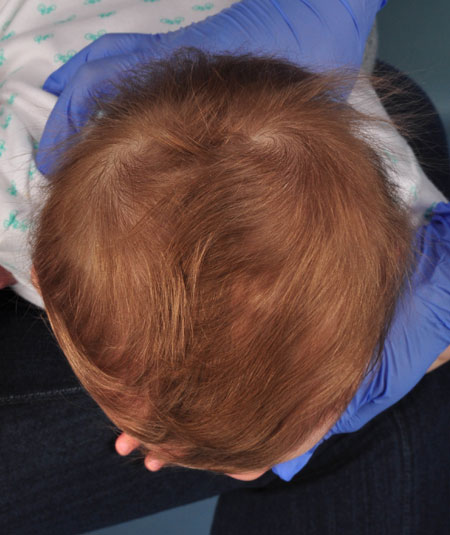 baby after strip craniectomy for metopic craniosynostosis