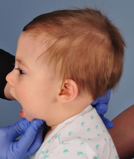 baby after strip craniectomy for metopic craniosynostosis