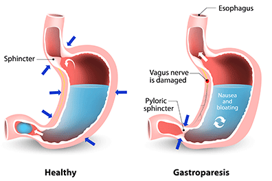 Gastroparesis - Children's Health