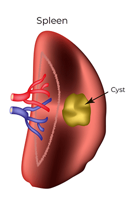 Pediatric spleen cyst - Children's Health