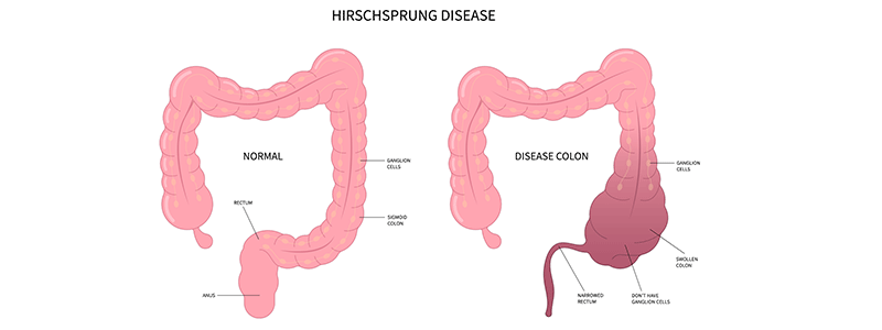 Hirschsprung's disease in children - Children's Health