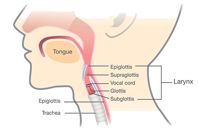 Laryngotracheal Cleft - Children's Health