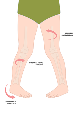 Femoral Anteversion - Pigeon Toed - Children's Health