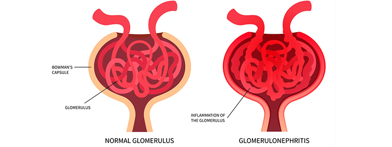 Pediatric glomerulonephritis - Children's Health