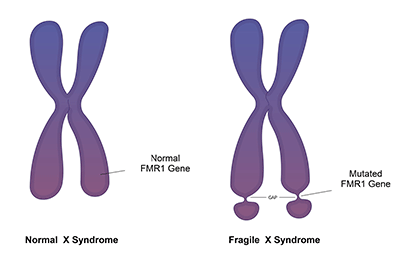 Fragile X Syndrome - Children's Health