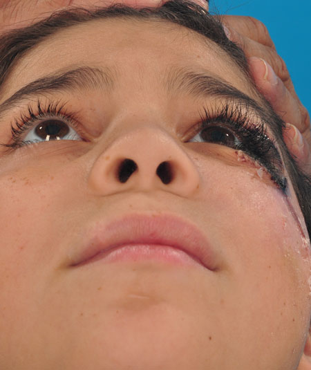 Before nevus removal by plastic surgery