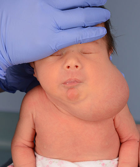 before venolymphatic malformation removal from infant