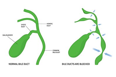 Biliary Atresia illistration - Children's Health