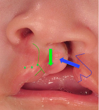 cleft lift repair schematic