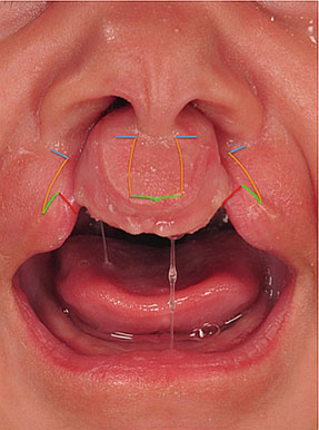 cleft lip repair figure