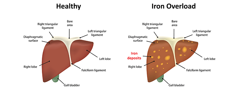 Hemochromatosis (Iron Overload) - Children's Health