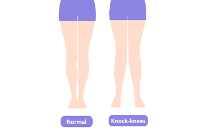 Pediatric knock knees - Children's Health