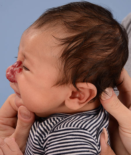 before photo baby boy with nasal hemangioma