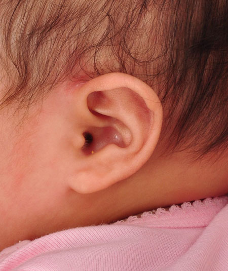 infant's ear after ear molding