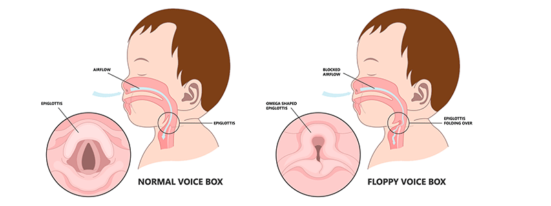 Laryngomalacia in children - Children's Health