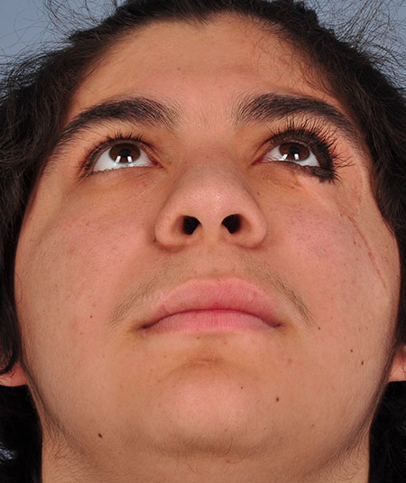 After nevus removal by plastic surgery
