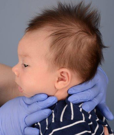 baby with metopic craniosynostosis before strip craniectomy