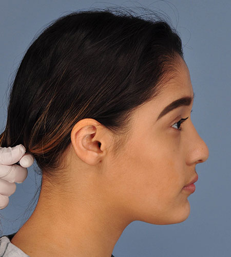 girl after rhinoplasty after nasal trauma