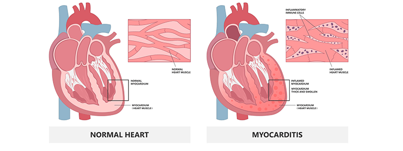 Myocarditis in children - Children's Health