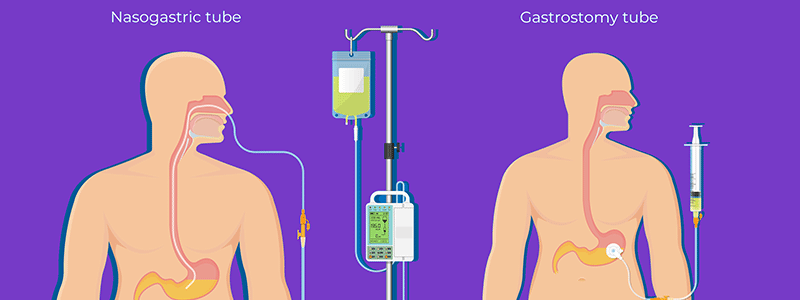 Tube feeding for children - Children's Health