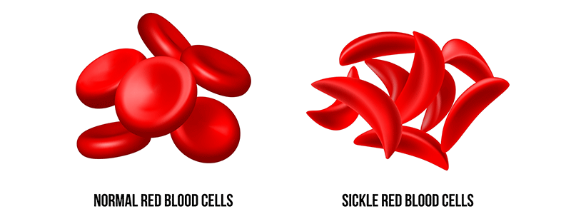 Sickle cell disease - Children's Health