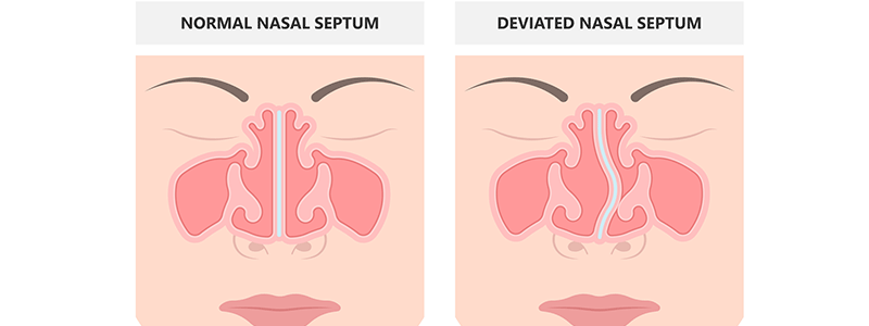 Pediatric deviated septum - Children's Health