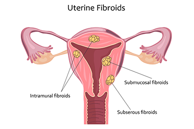 Uterine Fibroids in girls - Children's Health