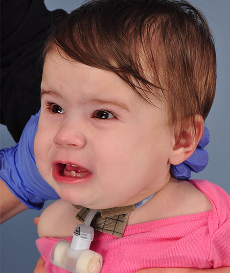 after venolymphatic malformation removal from infant