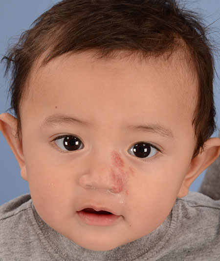 after photo of boy with nasal hemangioma removed