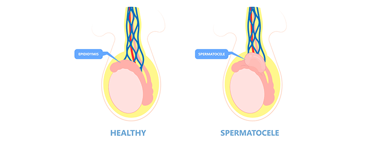 Epididymal Cyst (Spermatocele) - Children's Health