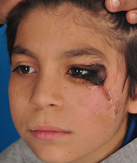 Before nevus removal by plastic surgery