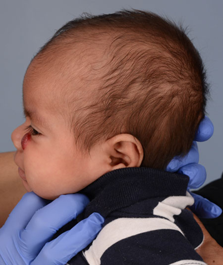 before photo baby boy with hemangioma under his eye
