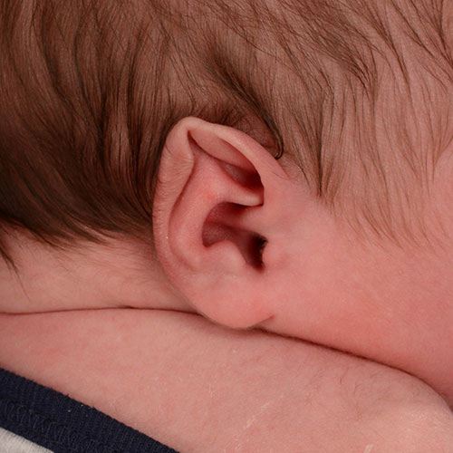 Baby with Stahl's ear before getting ear molding treatment