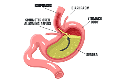 Gastroesophageal Reflux Disease (GERD) - Children's Health