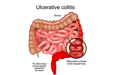 Pediatric ulcerative colitis (UC) - Children's Health