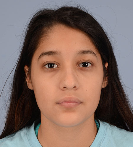 girl before rhinoplasty after nasal trauma