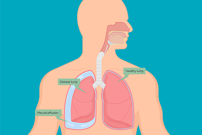 Pediatric pleural effusion - Children's Health