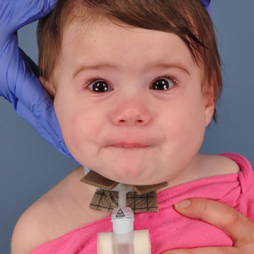 Infant after removal of venolymphatic malformation 