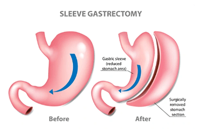 Sleeve Gastrectomy weight loss surgery - Children's Health