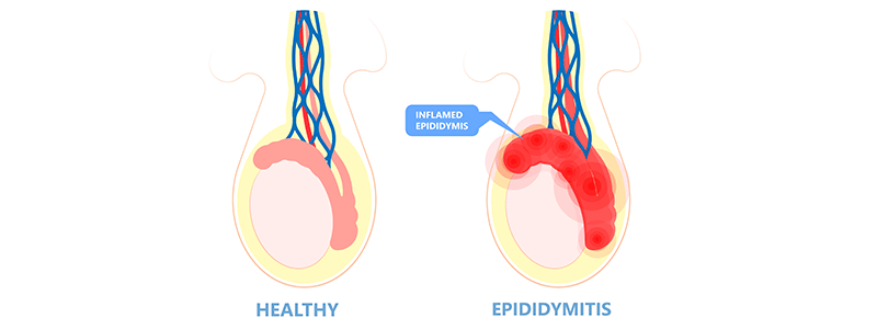 Pediatric epididymitis - Children's Health