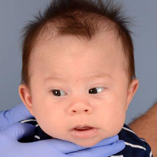 baby with metopic craniosynostosis before strip craniectomy
