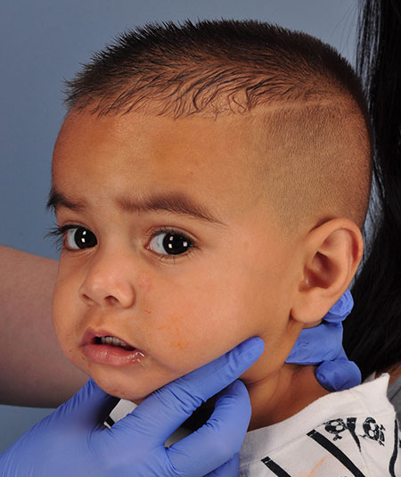 after photo of toddler boy with hemangioma removed